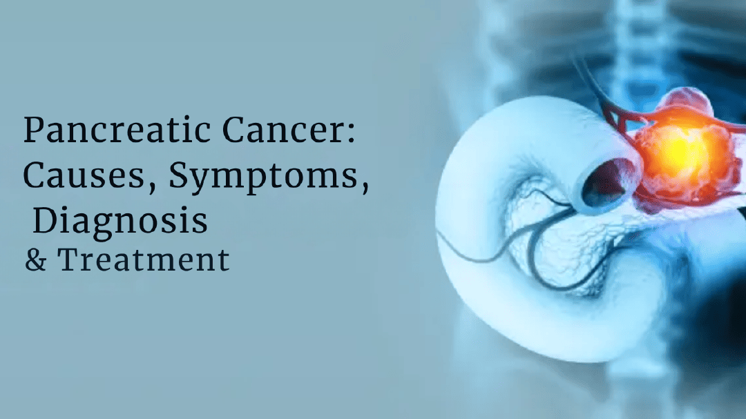 Symptoms of Pancreatic Cancer